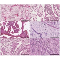 <b>【佳学基因检测】肾脏癌靶向药物基因检测（Kidney Cancer)</b>